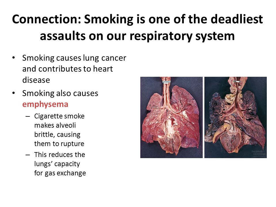 Smoking and lung disease